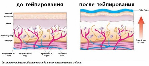 Тейпирование живота и боков для похудения. Схема, как делается, фото, результаты